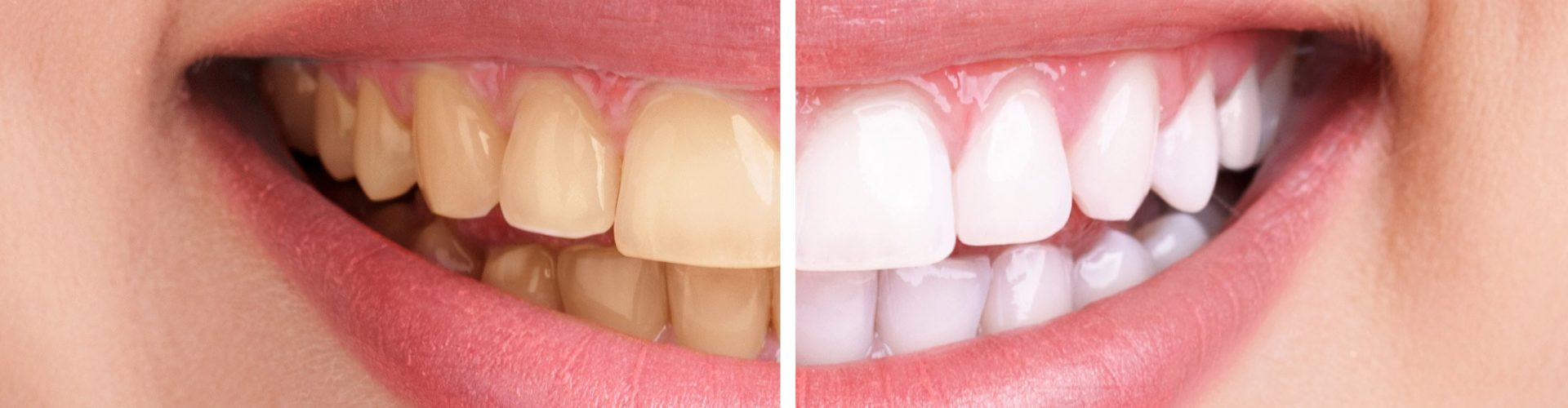 blanchiment-dentaire-avant-apres
