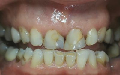 inconvenients-facette