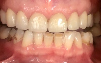 inconvenients-facette2