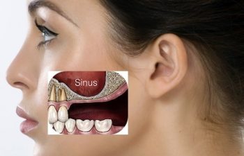 sinus-lift