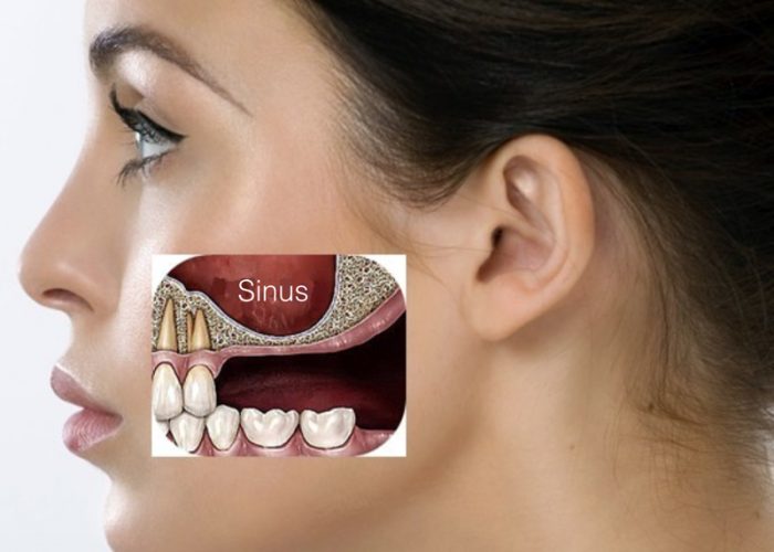 sinus-lift